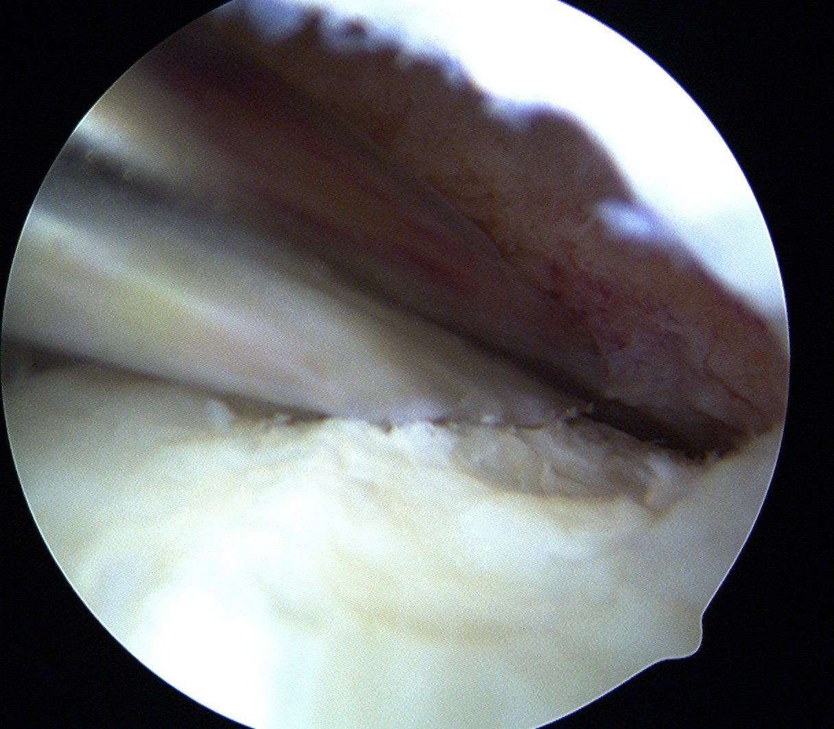 Femoral OCD Base Debridement